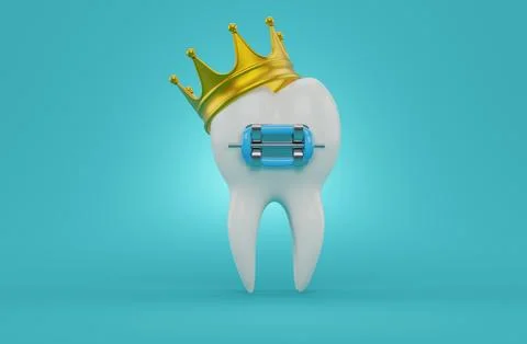 Tooth with brace and crown Stock Illustration