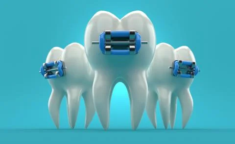 Tooth with brace Stock Illustration