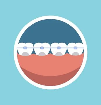 Tooth braces vector illustration Ilustración de archivo