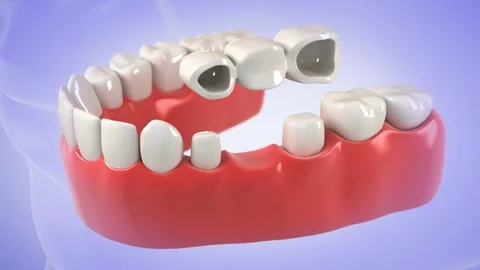 Tooth Bridge. High quality 3D animation showing the installation process Stock Footage 85302731