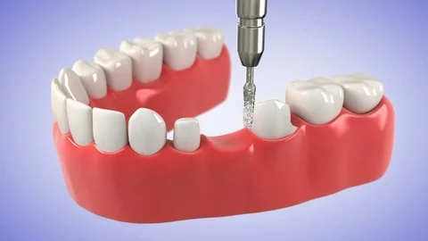 Tooth Bridge. High quality 3D animation showing the installation process. Stock Footage 85303110