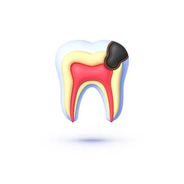 Tooth caries in 3d style. 3d vector isolated icon. Vector illustration Stock Illustration