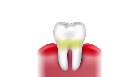 Tooth caries formation Stock Footage 69223068