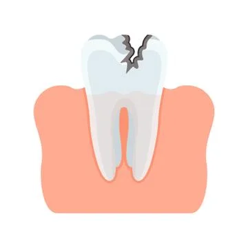 Tooth with caries Illustrazione stock