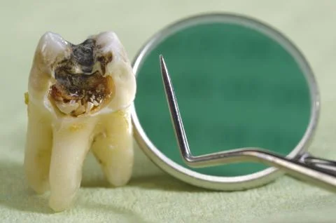 Tooth with caries Stock Photos