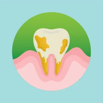 Tooth With Cavity Stock Illustration