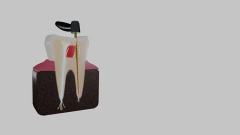 Tooth cross section with dental handpiece and endodontic file, 4K Stock Footage 346121040