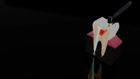 Tooth cross section showing root canal treatment and jawbone base, 4K Stock Footage 346121237