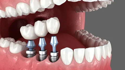 Tooth crowns placement over 3 implants. Dental 3D animation Stock Footage 314452576