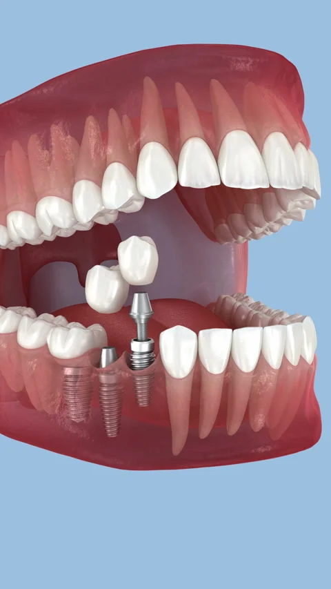 Tooth crowns placement over 3 implants. Dental 3D Animation Stock Footage 314453490
