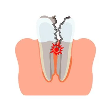Tooth damaged inflammation Illustrazione stock