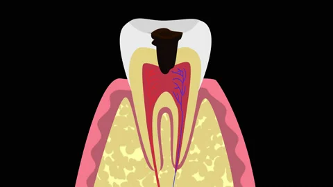 Tooth decay 4K alpha channel Stock Footage 132287504