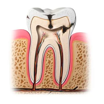 Tooth decay, artwork Stock Illustration