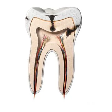 Tooth decay, artwork Stock Illustration
