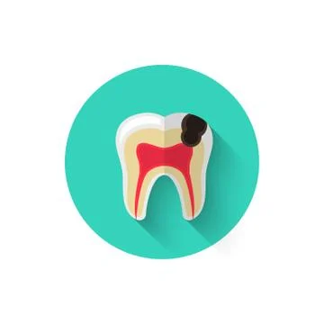 Tooth decay, caries illustrated in a flat style design of vector illustration Stock Illustration