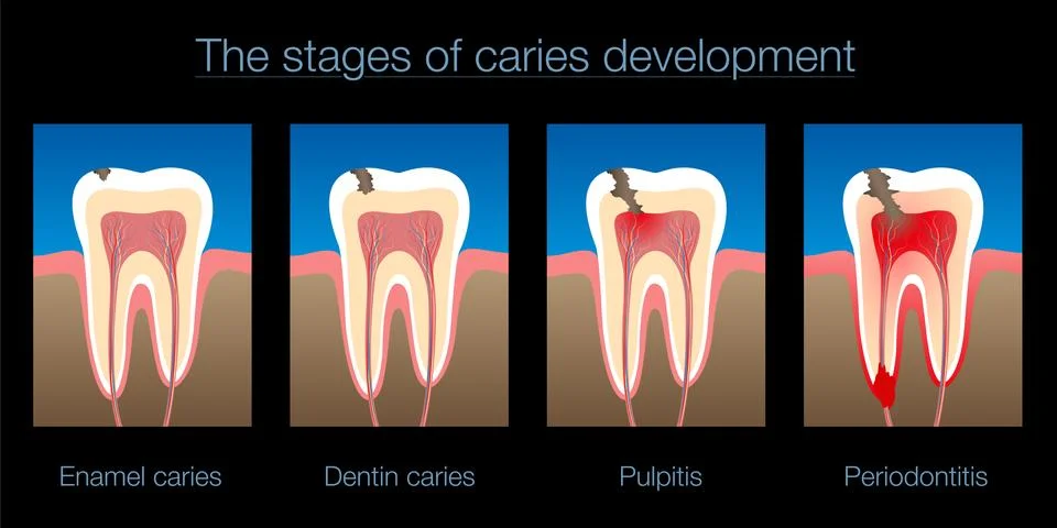 Tooth Decay Caries Stages Development Black Background Stock Illustration