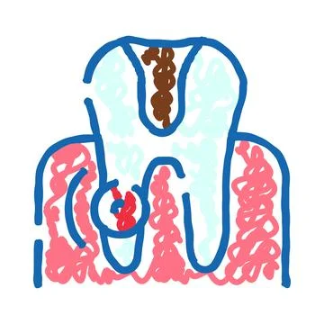 Tooth decay concept with infected root and gum Stock Illustration