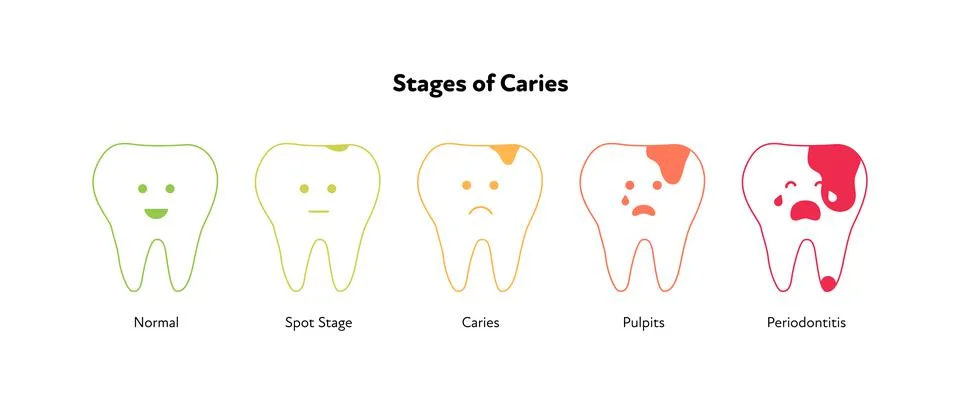 Tooth decay concept. Stage of teeth caries with face Stock Illustration