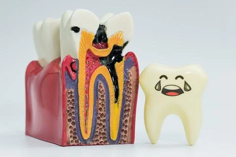 Tooth decay cross-section model with sad cartoon tooth Stock Photos