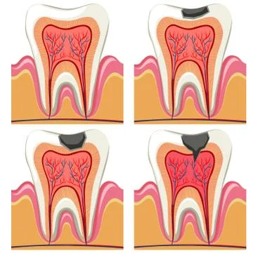 Tooth decay diagram in details Stock Illustration