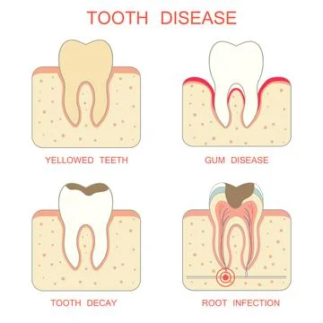 Tooth decay disease Illustrazione stock