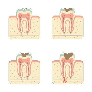 Tooth decay disease Stock Illustration