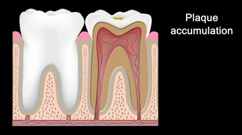 Tooth decay Video stock 7905423