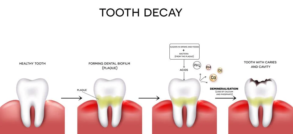 Tooth decay formation Stock Illustration