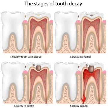 Tooth decay Stock Illustration