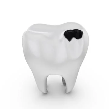 Tooth decay Stock Illustration