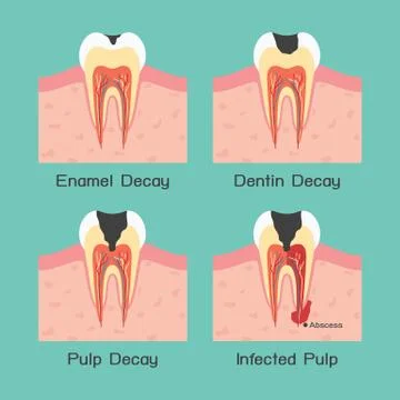 Tooth decay Illustrazione stock
