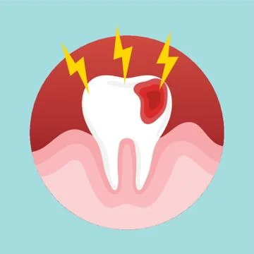 Tooth Decay Illustrazione stock