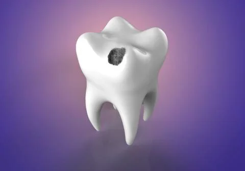 Tooth decay, illustration Illustrazione stock