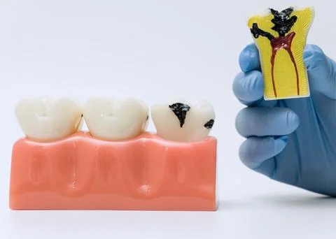 Tooth decay model and pulp infection cross-section Stock Photos