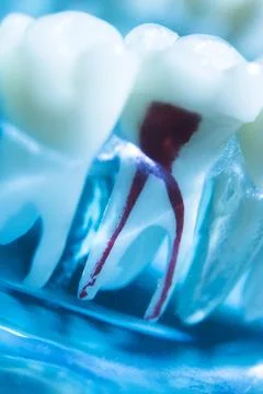 Tooth decay Stock Photos