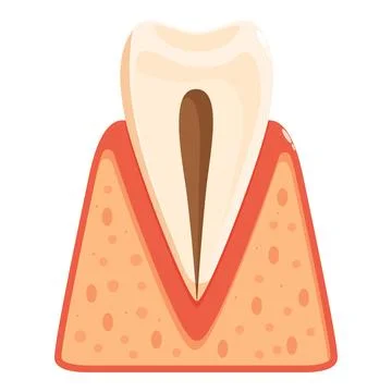 Tooth decay showing affected dentin and pulp illustrating gingivitis Illustrazione stock