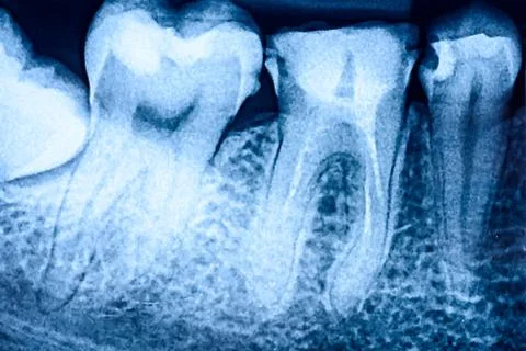 Tooth Decay On X-Ray Stock Illustration
