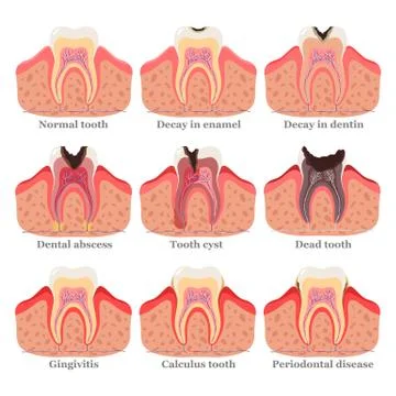 Tooth disorders set, flat vector illustration. Healthy and unhealthy teeth Stockillustratie