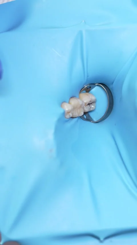 Tooth Extraction in Dentistry Stock Footage 316914929