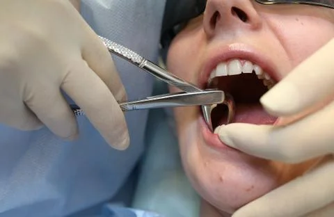 Tooth extraction in dentistry. Stock Photos