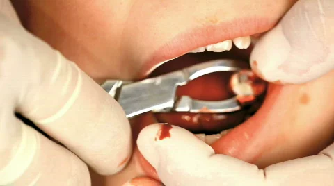 Tooth extraction 스톡 동영상 779816