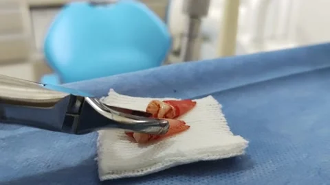 Tooth extraction 스톡 동영상 165313401