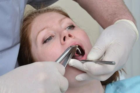 Tooth Extraction procedure with forceps, closeup portrait of woman patient Stock Photos