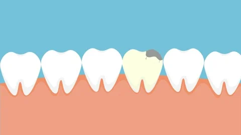 Tooth getting cavities and cracking down 4K animation. Dentist pulling up a d 库存影片 186408044