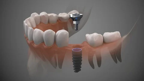 Tooth human implant Stock Footage 122197330
