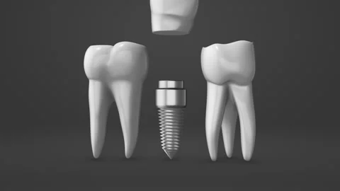 Tooth implant and crown installation process Video stock 252129229