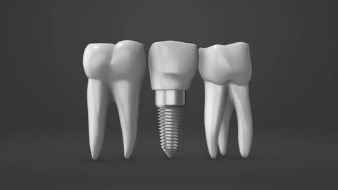 Tooth implant and crown installation process Ilustración de archivo