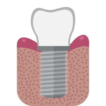 Tooth implant in bone Stock Illustration