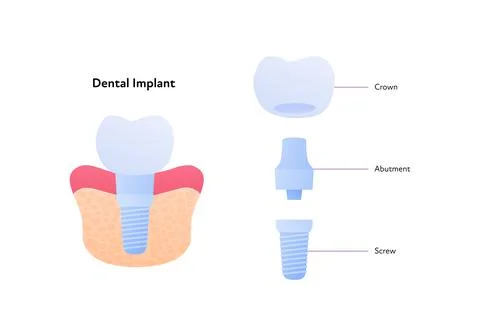 Tooth implant chart. Teeth prosthesis scheme Cross section. Stock Illustration
