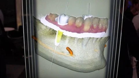 Tooth Implant Display 库存影片 92620736